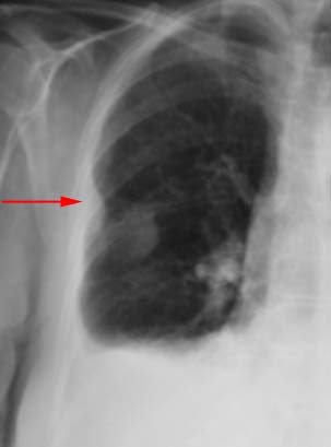 Ardoise Fibrociment : Danger Encouru et Solutions